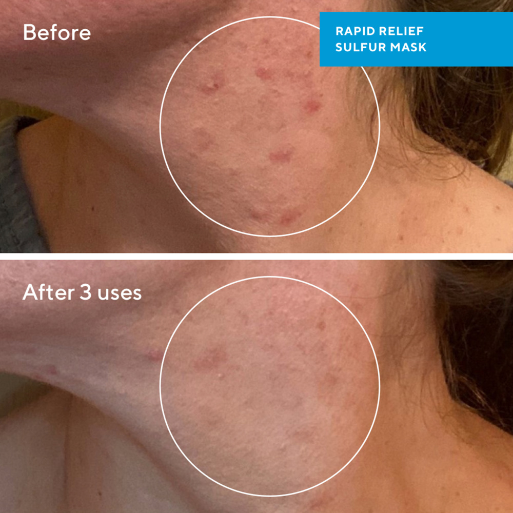 Rapid Relief Sulfur Mask, 75ml