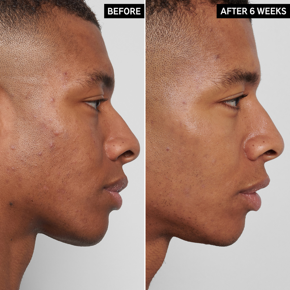 Mandelic Acid Treatment, 15ml