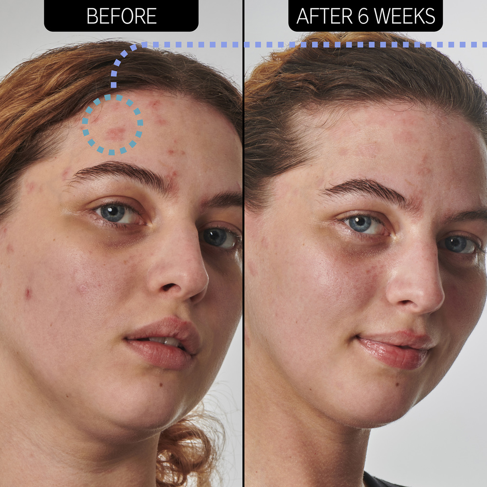 Urea 10% Moisturizer, 50ml