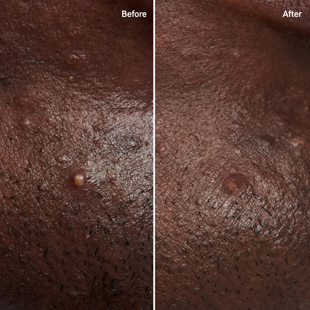 Hydrocolloid Invisible Pimple, 22 Patches