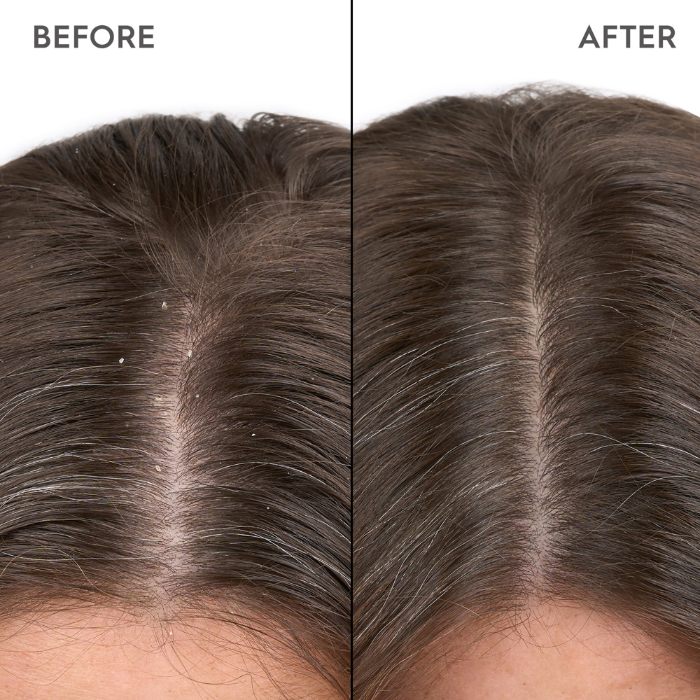 Anti-Dandruff Shampoo