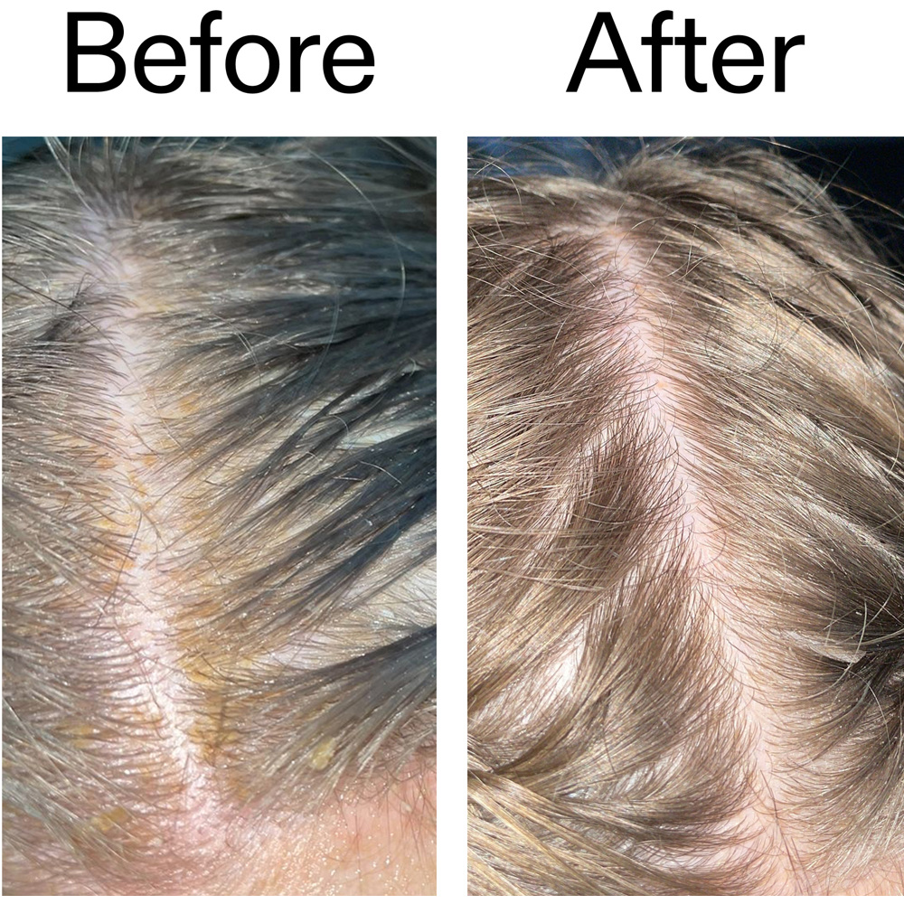 Salicylic Acid Exfoliating Scalp Treatment, 150ml