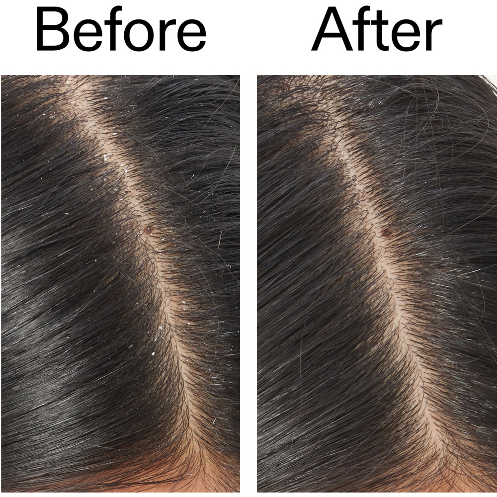 Salicylic Acid Exfoliating Scalp Treatment, 150ml