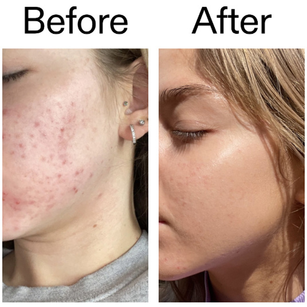 Beta Hydroxy Acid Serum, 30ml