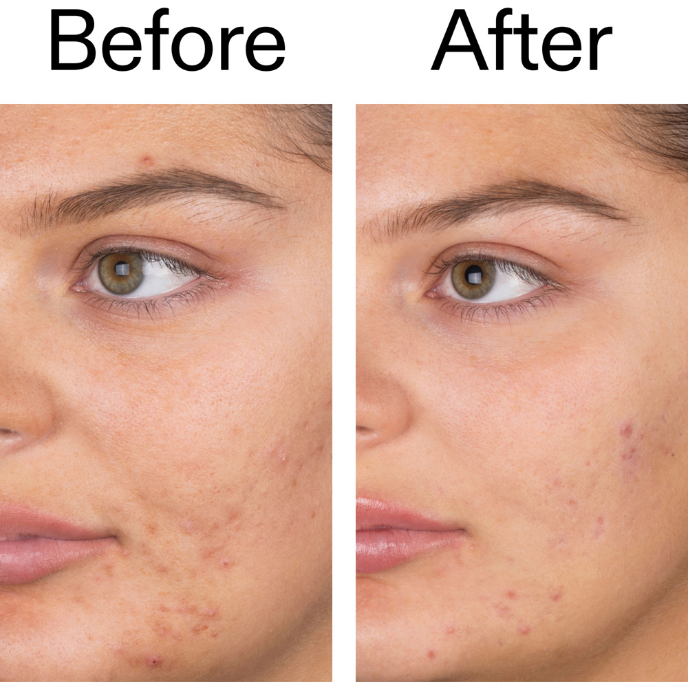 Salicylic Acid Cleanser