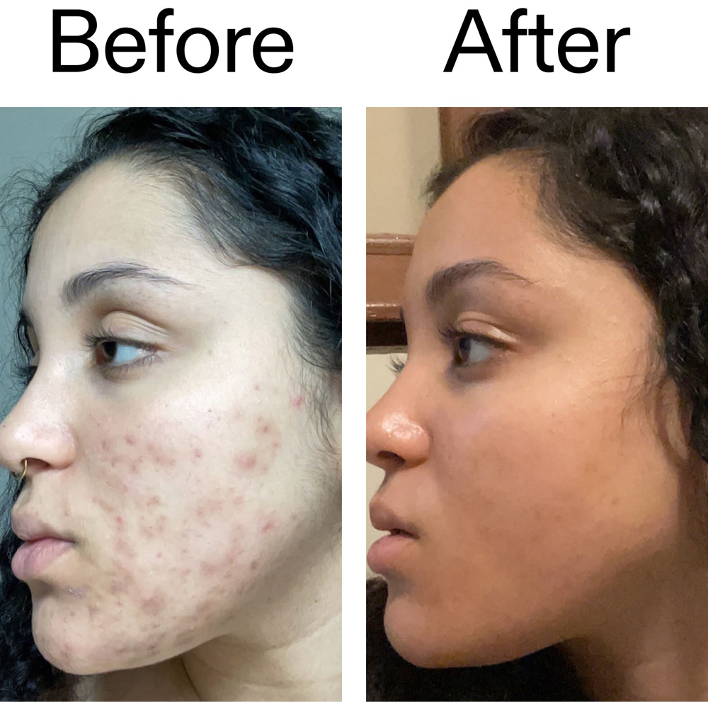 Tranexamic Acid Serum, 30ml