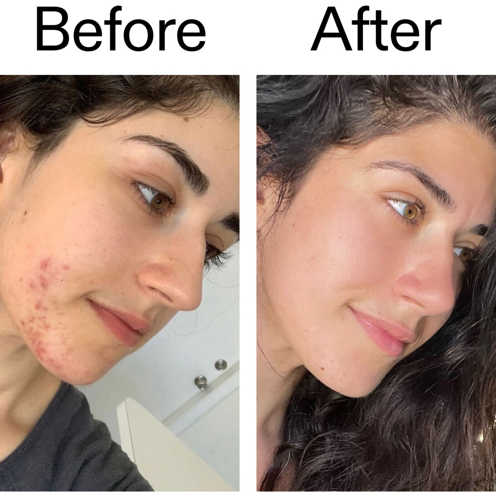 Succinic Acid Treatment, 15ml