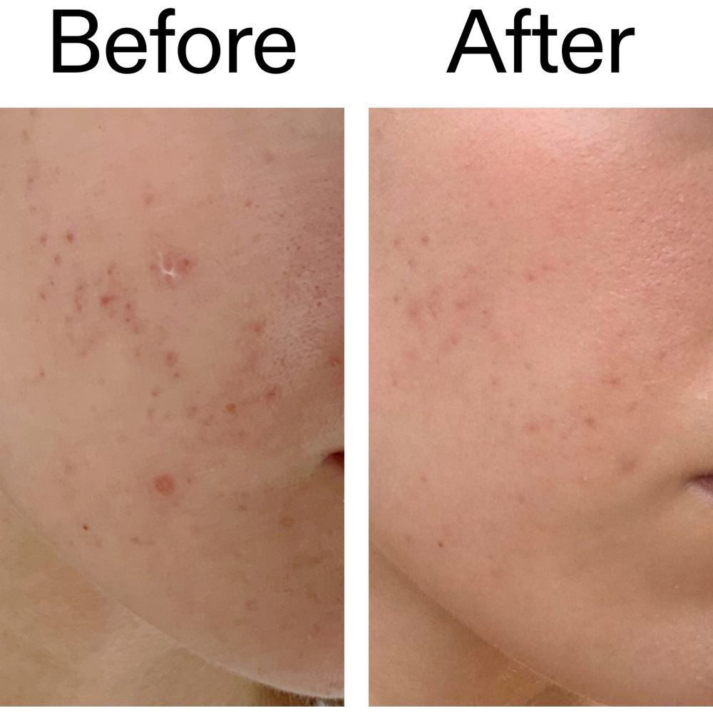 Mandelic Acid Treatment, 15ml