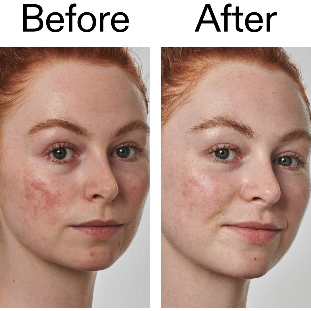 Azelaic Acid 10% Serum, 30ml