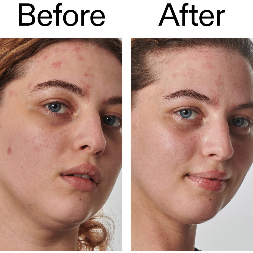 Urea 10% Moisturizer, 50ml