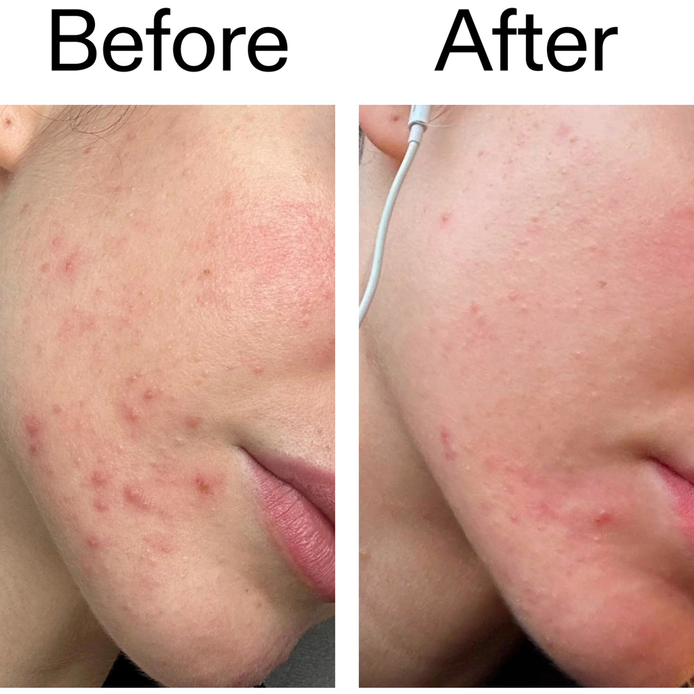 Blemish Clearing Moisturizer 2% Novoretin, 50ml