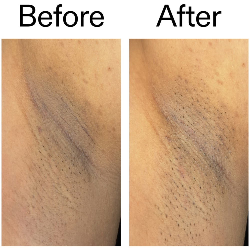 Glycolic Acid Exfoliating Body Stick, 45g