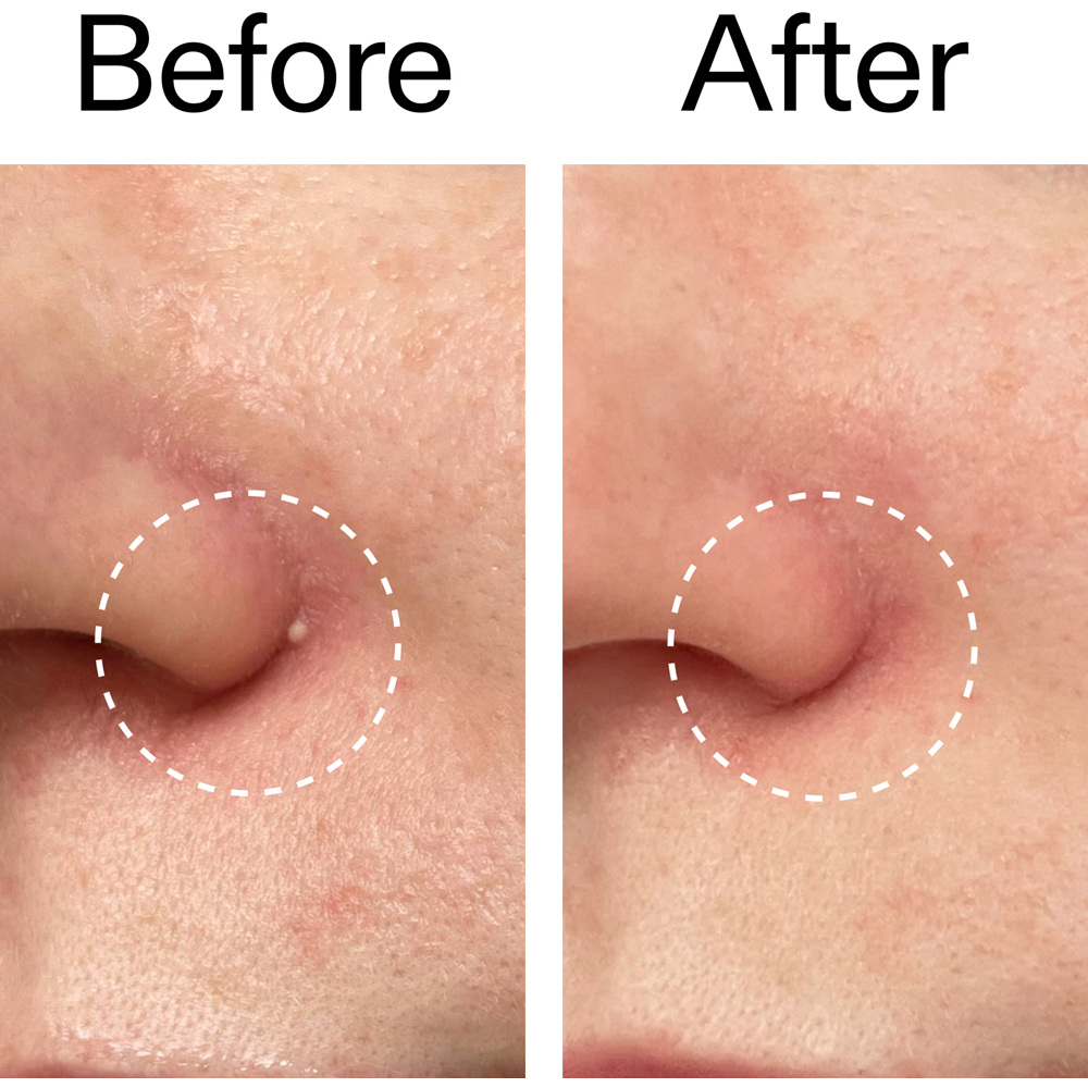 Hydrocolloid Invisible Pimple, 22 Patches