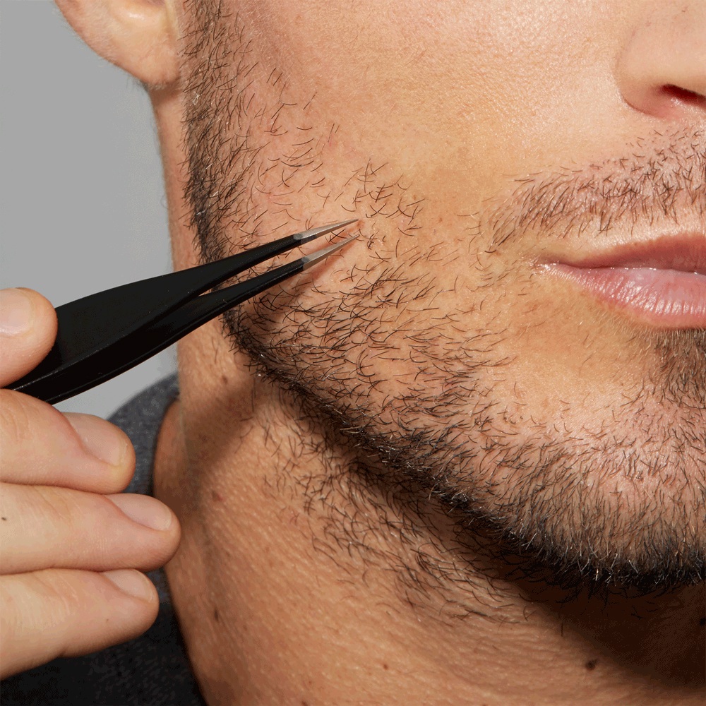 Ingrown Hair/Splintertweeze